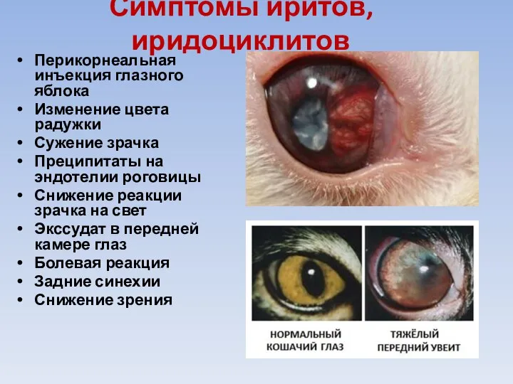 Симптомы иритов, иридоциклитов Перикорнеальная инъекция глазного яблока Изменение цвета радужки Сужение зрачка