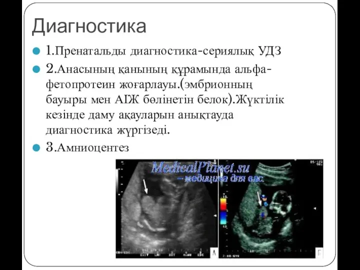 Диагностика 1.Пренатальды диагностика-сериялық УДЗ 2.Анасының қанының құрамында альфа-фетопротеин жоғарлауы.(эмбрионның бауыры мен АІЖ