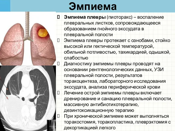 Эмпиема Эмпиема плевры (пиоторакс) – воспаление плевральных листков, сопровождающееся образованием гнойного экссудата