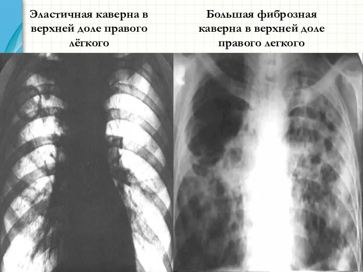 Эластичная каверна в верхней доле правого лёгкого Большая фиброзная каверна в верхней доле правого легкого