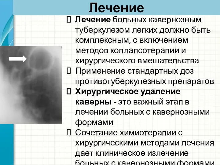 Лечение Лечение больных кавернозным туберкулезом легких должно быть комплексным, с включением методов