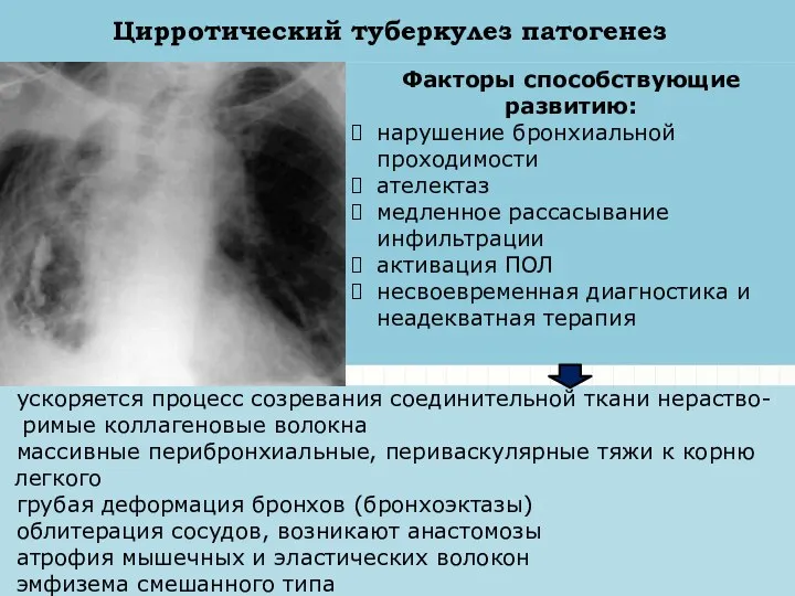 Цирротический туберкулез патогенез Факторы способствующие развитию: нарушение бронхиальной проходимости ателектаз медленное рассасывание