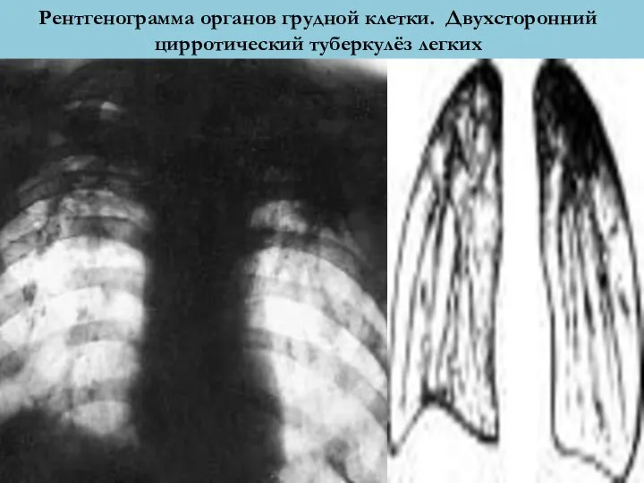 Рентгенограмма органов грудной клетки. Двухсторонний цирротический туберкулёз легких