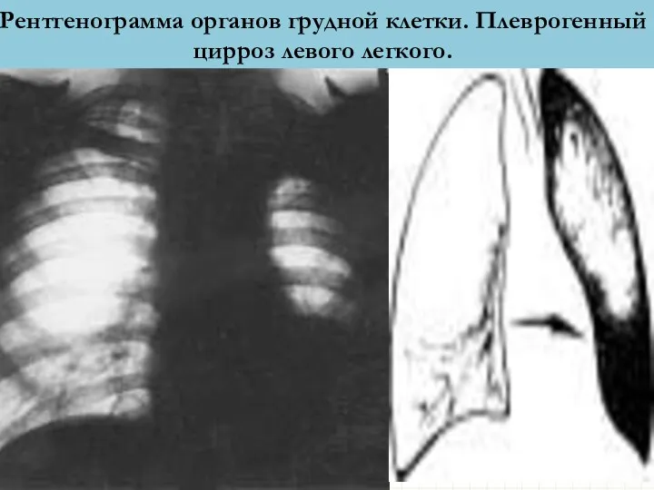 Рентгенограмма органов грудной клетки. Плеврогенный цирроз левого легкого.