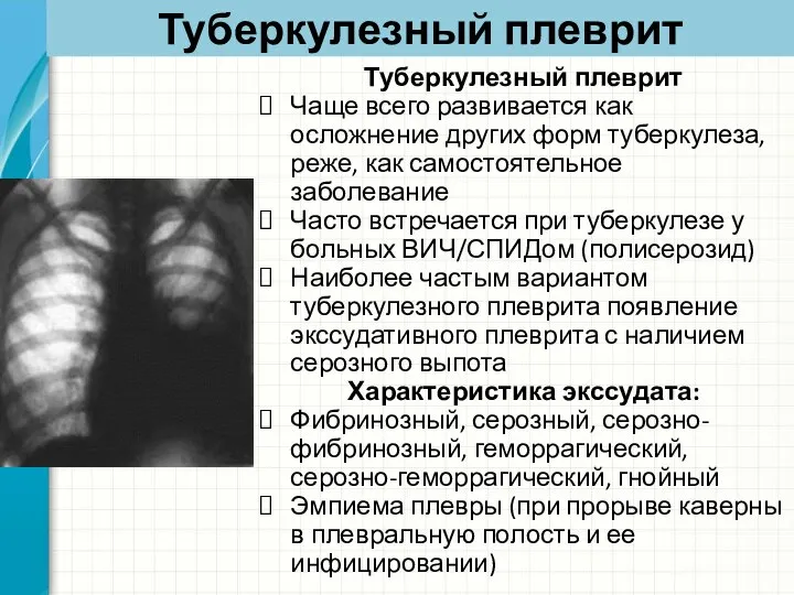 Туберкулезный плеврит Туберкулезный плеврит Чаще всего развивается как осложнение других форм туберкулеза,