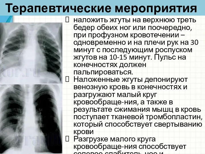 Терапевтические мероприятия наложить жгуты на верхнюю треть бедер обеих ног или поочередно,