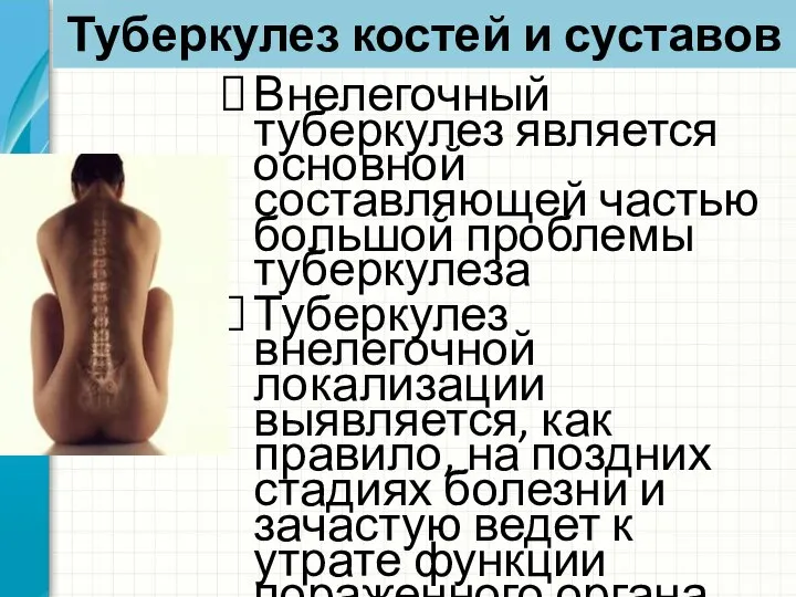 Туберкулез костей и суставов Внелегочный туберкулез является основной составляющей частью большой проблемы