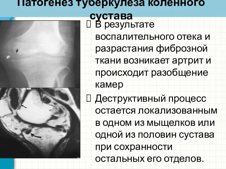 Патогенез туберкулеза коленного сустава В результате воспалительного отека и разрастания фиброзной ткани