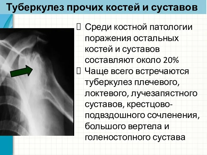 Туберкулез прочих костей и суставов Среди костной патологии поражения остальных костей и