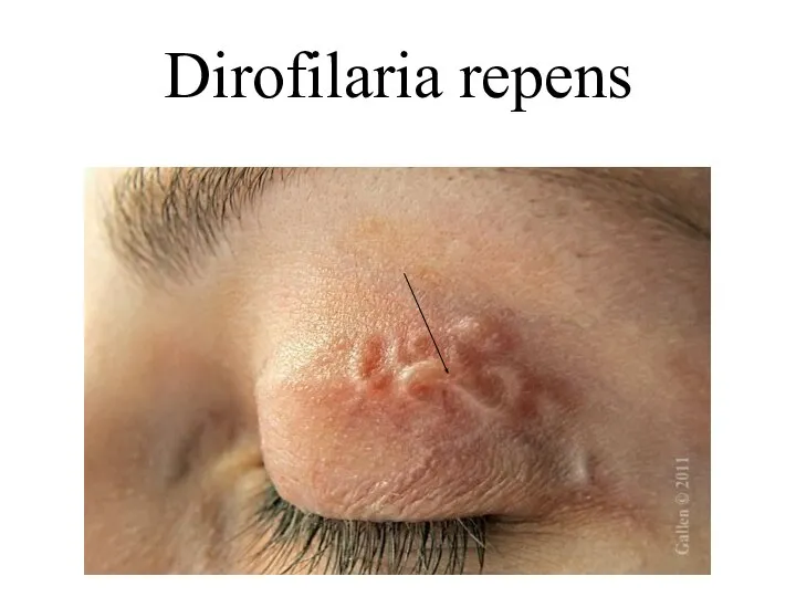 Dirofilaria repens