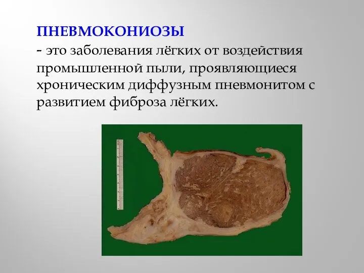 ПНЕВМОКОНИОЗЫ - это заболевания лёгких от воздействия промышленной пыли, проявляющиеся хроническим диффузным