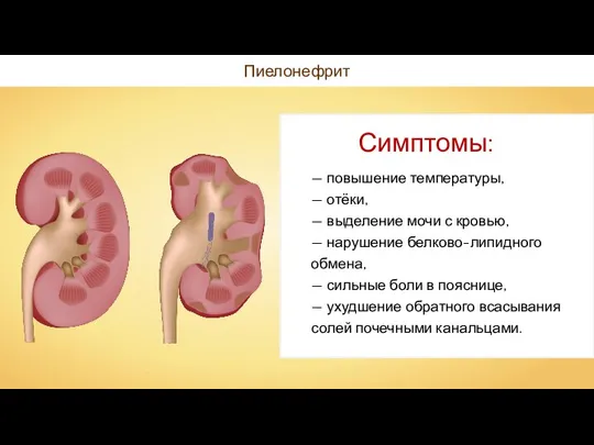 Пиелонефрит — повышение температуры, — отёки, — выделение мочи с кровью, —