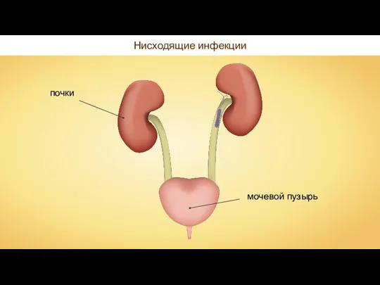 Нисходящие инфекции