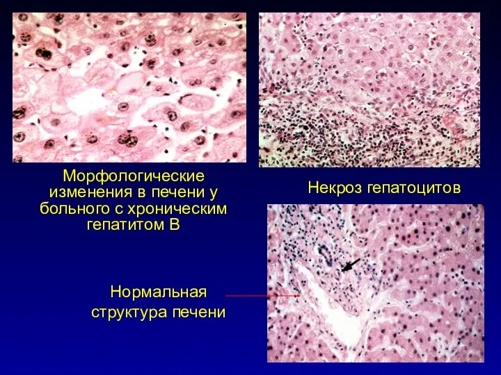 Морфологические изменения в печени у больного с хроническим гепатитом В Некроз гепатоцитов Нормальная структура печени