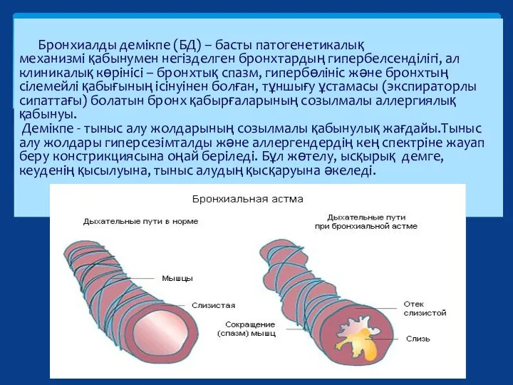 Бронхиалды демікпе (БД) – басты патогенетикалық механизмі қабынумен негізделген бронхтардың гипербелсенділігі, ал