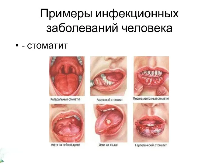 Примеры инфекционных заболеваний человека - стоматит