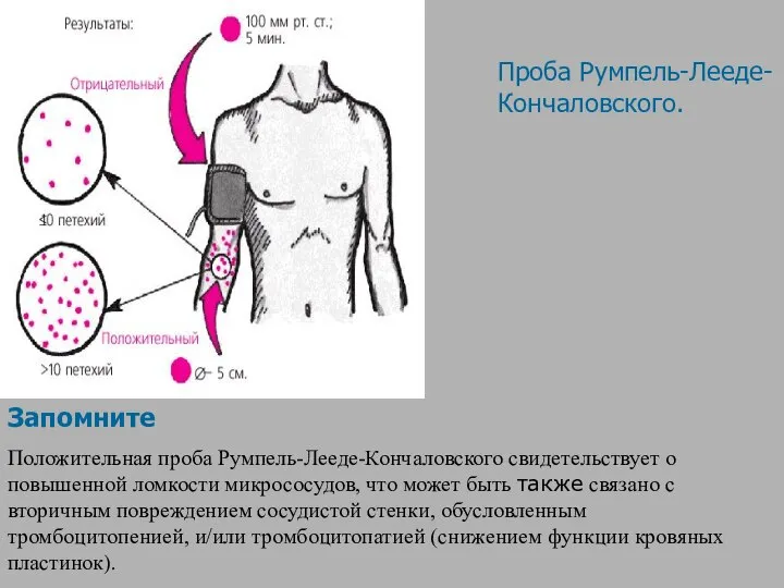 Запомните Положительная проба Румпель-Лееде-Кончаловского свидетельствует о повышенной ломкости микрососудов, что может быть