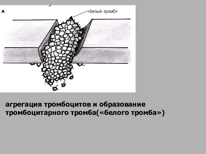 агрегация тромбоцитов и образование тромбоцитарного тромба(«белого тромба»)