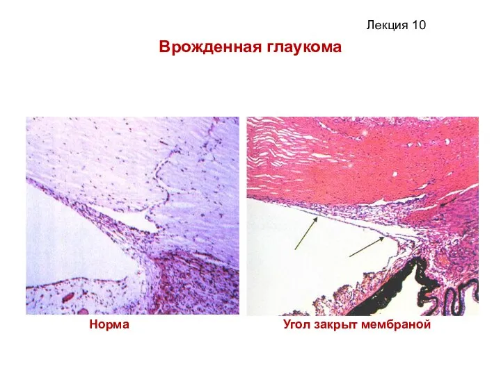 Врожденная глаукома Норма Угол закрыт мембраной