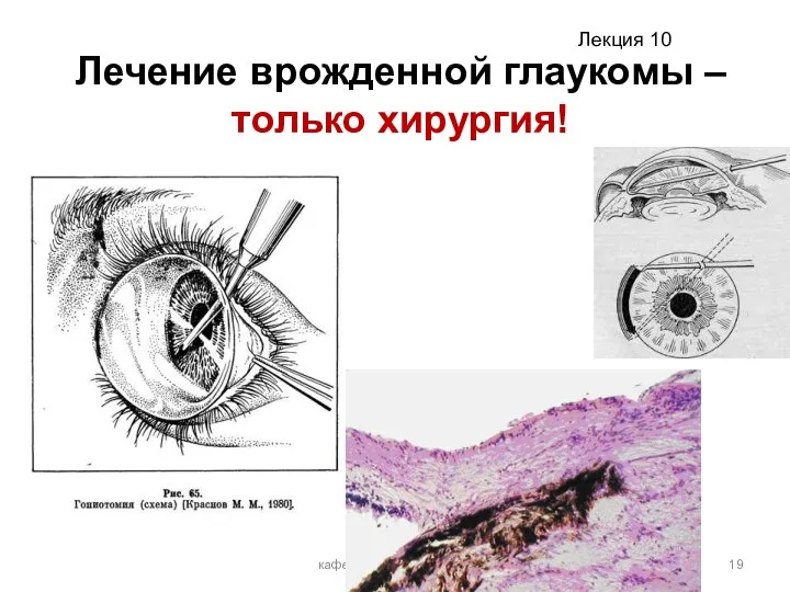 Лечение врожденной глаукомы – только хирургия! кафедра офтальмологии