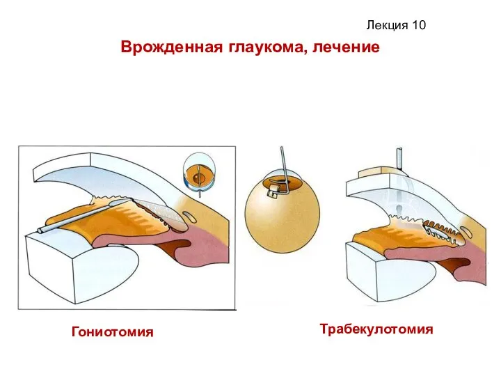 Врожденная глаукома, лечение Трабекулотомия Гониотомия