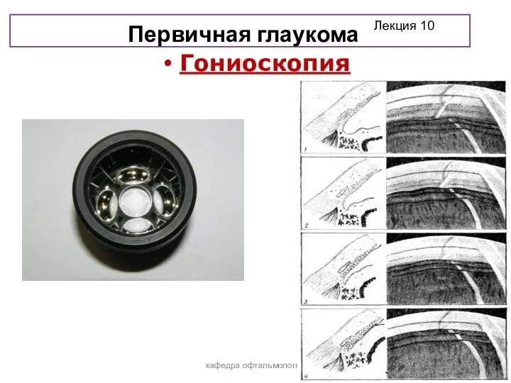 Первичная глаукома Гониоскопия кафедра офтальмологии