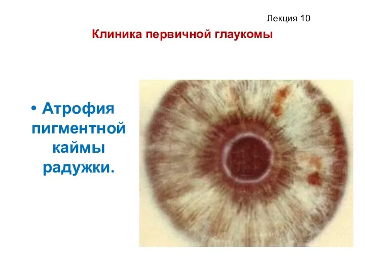 Клиника первичной глаукомы Атрофия пигментной каймы радужки.
