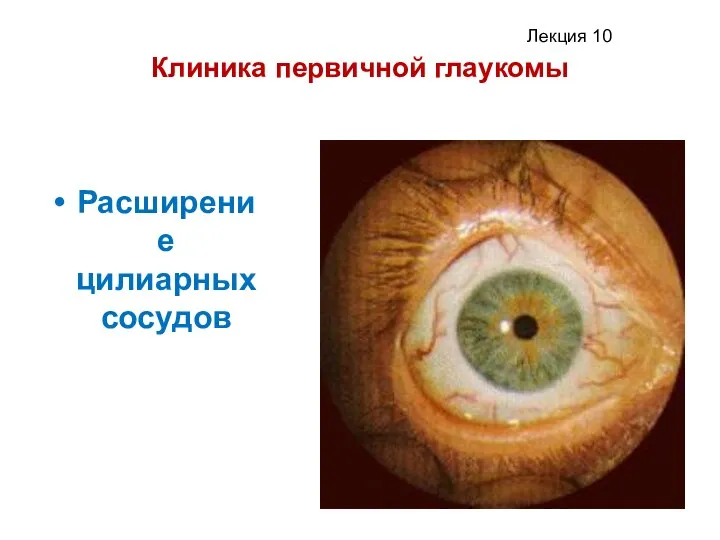 Клиника первичной глаукомы Расширение цилиарных сосудов