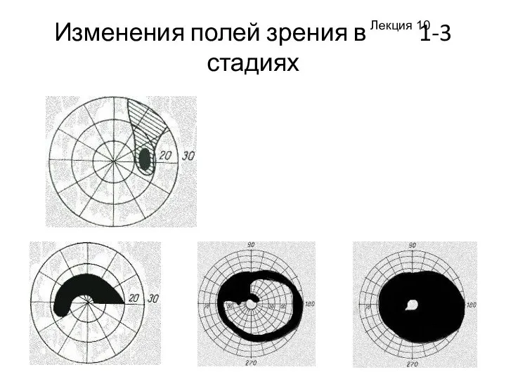 Изменения полей зрения в 1-3 стадиях