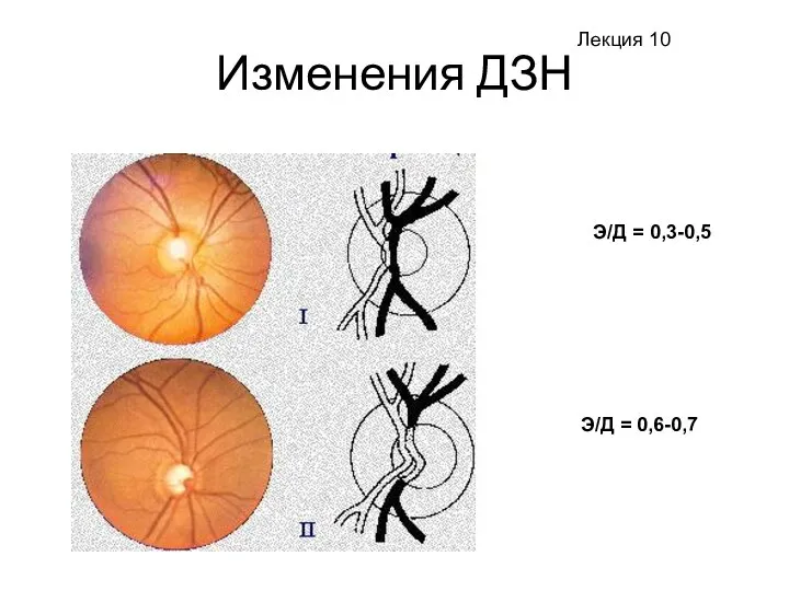 Изменения ДЗН Э/Д = 0,3-0,5 Э/Д = 0,6-0,7