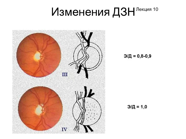 Изменения ДЗН Э/Д = 0,8-0,9 Э/Д = 1,0