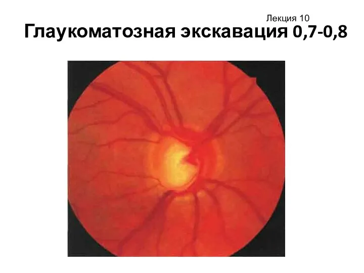 Глаукоматозная экскавация 0,7-0,8