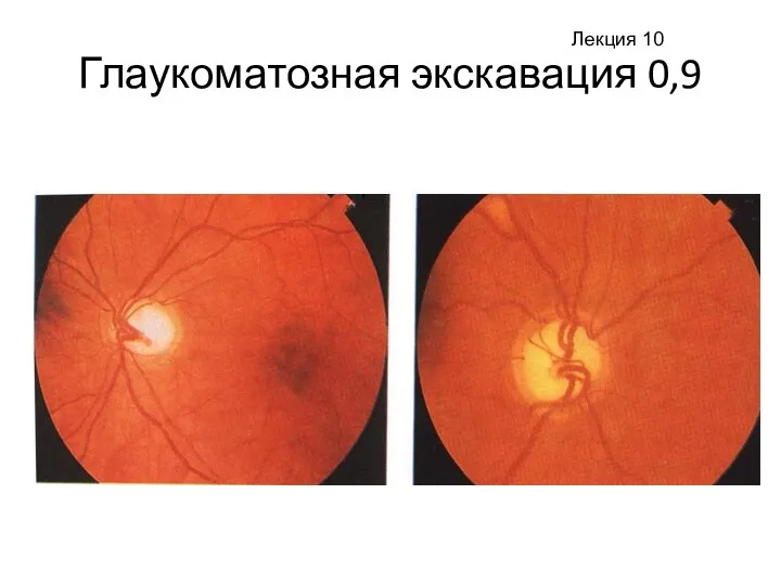 Глаукоматозная экскавация 0,9