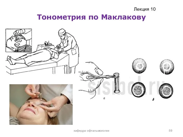 Тонометрия по Маклакову кафедра офтальмологии