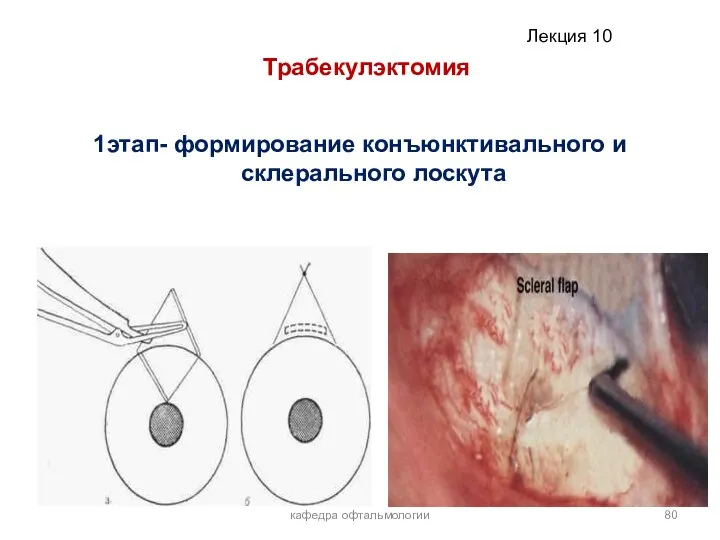 кафедра офтальмологии Трабекулэктомия 1этап- формирование конъюнктивального и склерального лоскута