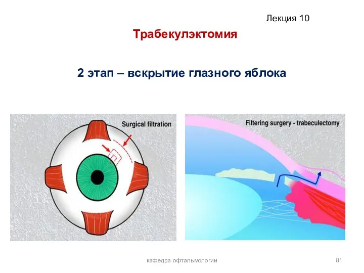 кафедра офтальмологии Трабекулэктомия 2 этап – вскрытие глазного яблока