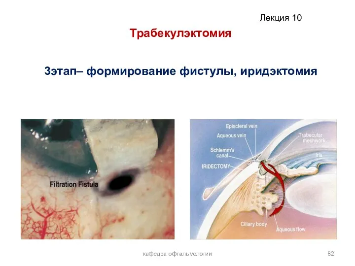 кафедра офтальмологии Трабекулэктомия 3этап– формирование фистулы, иридэктомия