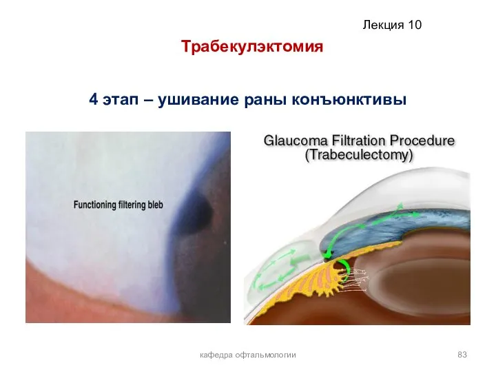 кафедра офтальмологии Трабекулэктомия 4 этап – ушивание раны конъюнктивы