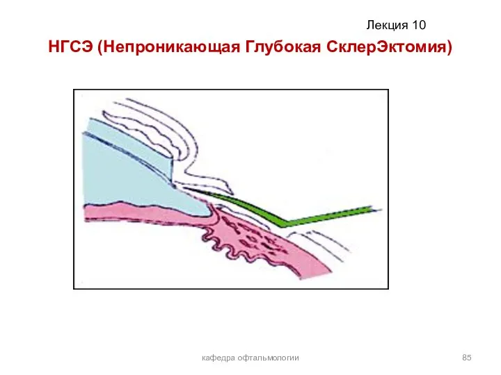 НГСЭ (Непроникающая Глубокая СклерЭктомия) кафедра офтальмологии