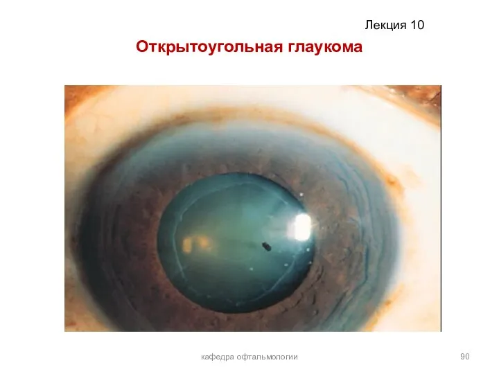 Открытоугольная глаукома кафедра офтальмологии