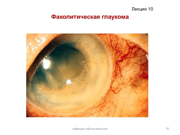 Факолитическая глаукома кафедра офтальмологии