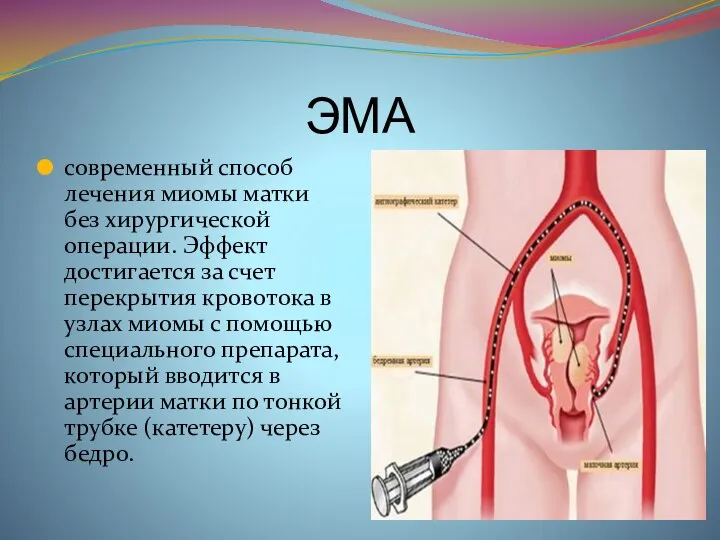 ЭМА современный способ лечения миомы матки без хирургической операции. Эффект достигается за