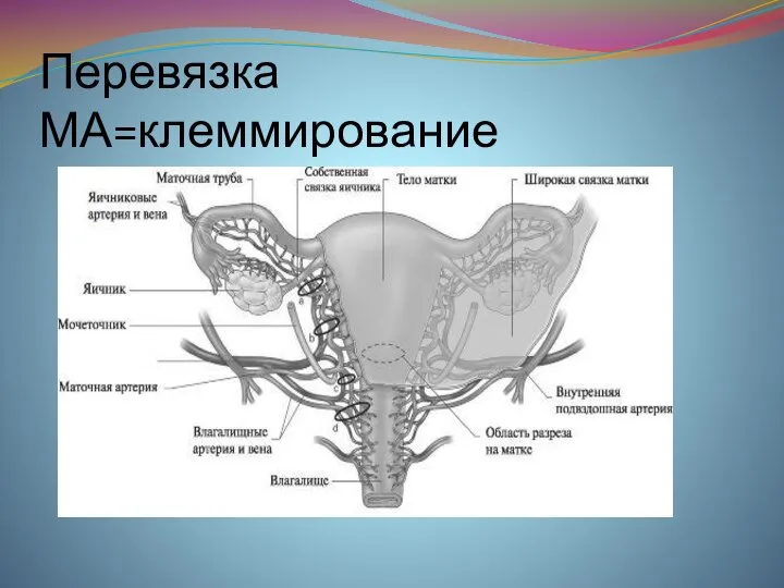 Перевязка МА=клеммирование