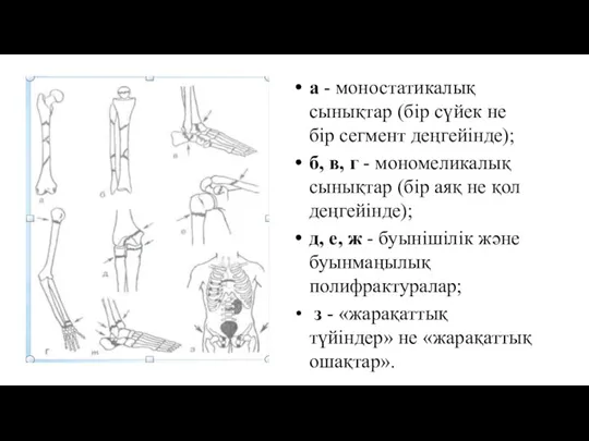 а - моностатикалық сынықтар (бір сүйек не бір сегмент деңгейінде); б, в,