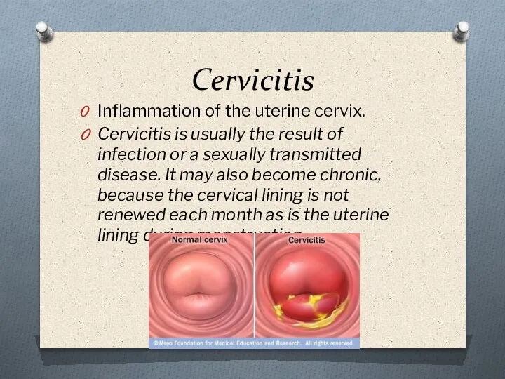 Cervicitis Inflammation of the uterine cervix. Cervicitis is usually the result of