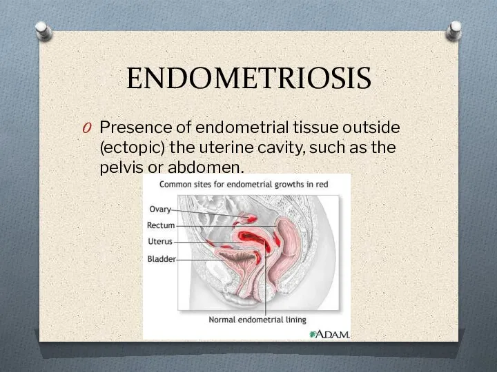 ENDOMETRIOSIS Presence of endometrial tissue outside (ectopic) the uterine cavity, such as the pelvis or abdomen.