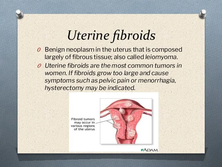 Uterine fibroids Benign neoplasm in the uterus that is composed largely of