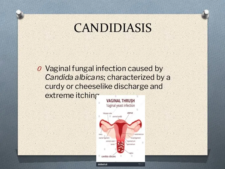 CANDIDIASIS Vaginal fungal infection caused by Candida albicans; characterized by a curdy