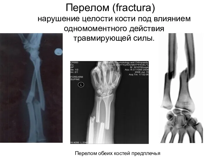 Перелом (fractura) нарушение целости кости под влиянием одномоментного действия травмирующей силы.