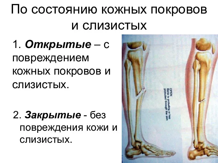 1. Открытые – с повреждением кожных покровов и слизистых. 2. Закрытые -